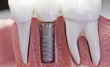 Compare Reviews, Prices & Costs of Dentistry in Bangalore at Pranam Dental and Implant Center -Majestic,Bangalore | M-IN1-7