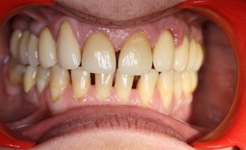 Compare Reviews, Prices & Costs of Dentistry Packages in Greece at Your Smile Dental Care | M-GP1-8