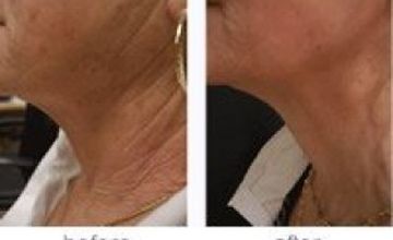 Compare Reviews, Prices & Costs of Cosmetology in Merseyside at A.R.A Aesthetics Group | M-UN1-231