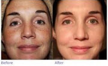 Compare Reviews, Prices & Costs of Dermatology in Telangana at skin aesthetique | M-IN7-12