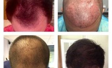 Compare Reviews, Prices & Costs of Hair Restoration in West Yorkshire at Better Hair Transplant Clinics - Leeds | M-UN1-541