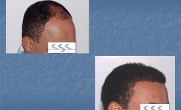 Compare Reviews, Prices & Costs of Hair Restoration in Dominican Republic at Hair Transplant Institute - Dr. Alba Reyes, MD | M-DO1-9