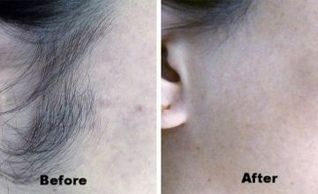 Compare Reviews, Prices & Costs of Cosmetology in East Sussex at OFF Skin & Laser Clinic | M-UN1-553