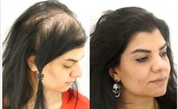 Compare Reviews, Prices & Costs of Hair Restoration in West Yorkshire at Want Hair | M-UN1-563