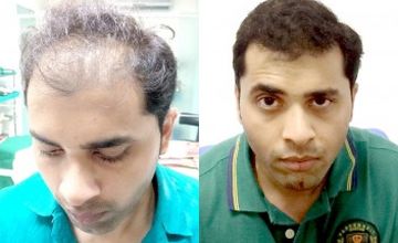 Compare Reviews, Prices & Costs of Hair Restoration in Chennai at Dr Anjali Shere's Hair Science Chennai | M-IN3-4