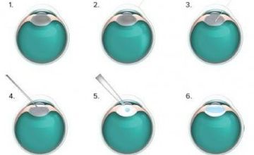 Compare Reviews, Prices & Costs of Ophthalmology in West Midlands at Optegra Eye Health Care Birmingham | M-UN1-832