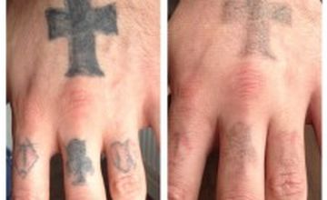 Compare Reviews, Prices & Costs of Cosmetology in Greater Manchester at The Missing Ink: Laser Tattoo Removal | M-UN1-1167