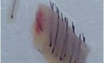 Compare Reviews, Prices & Costs of Hair Restoration in Mexico City at Uranga Hair Center | M-ME7-34