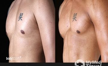 Compare Reviews, Prices & Costs of Regenerative Medicine in Dallas at bodySCULPT | AF78B5