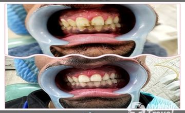 Compare Reviews, Prices & Costs of Allergology in Pune at The Dental Port | 05FF1E