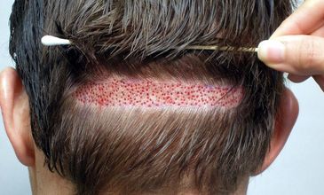 10 Best Clinics for Hair Transplant in Cyprus [2023 Prices]