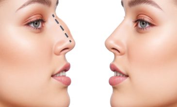 Nose Surgery