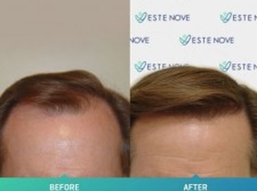 EsteNove Hair Transplant Clinic Turkey