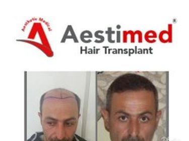 Aestimed Hair Transplant