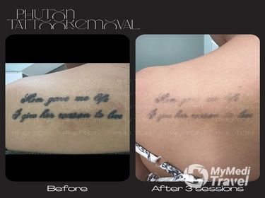 PHU TON - Laser Tattoo Removal