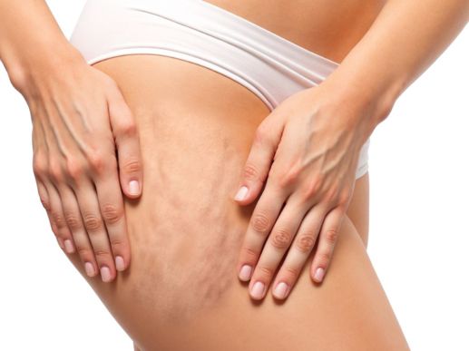 Search and Compare the Best Clinics and Doctors at the Lowest Prices for Cellulite Treatment in Nakhon Ratchasima