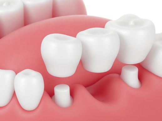 Search and Compare the Best Clinics and Doctors at the Lowest Prices for Dental Bridge in Taiwan