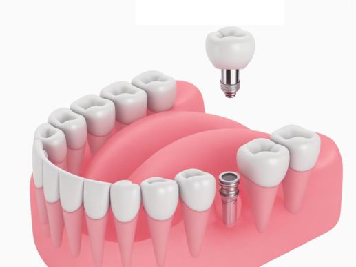 Search and Compare the Best Clinics and Doctors at the Lowest Prices for Dental Implant Bars in Tunisia