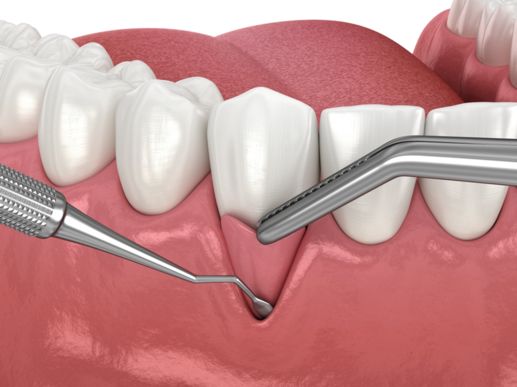 Search and Compare the Best Clinics and Doctors at the Lowest Prices for Gum Tissue Graft in Athens