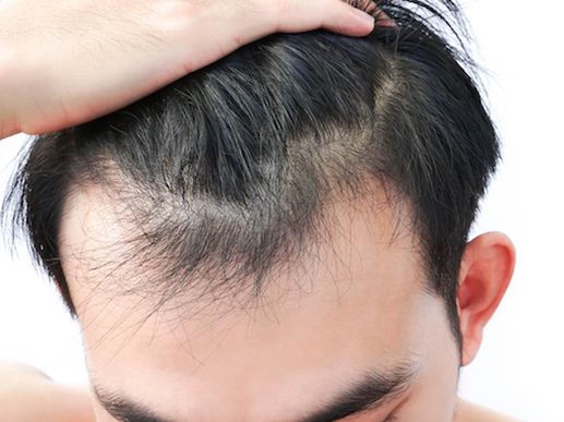 Search and Compare the Best Clinics and Doctors at the Lowest Prices for Hair Loss Treatment in Metro Manila