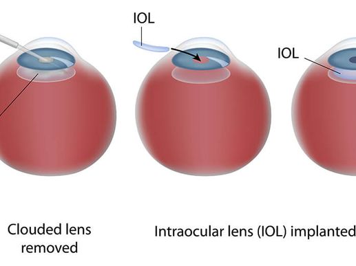 Search and Compare the Best Clinics and Doctors at the Lowest Prices for Intraocular Lens (IOL) Implant in Berlin