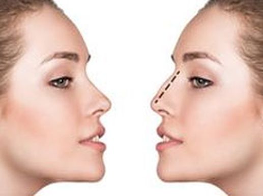 Search and Compare the Best Clinics and Doctors at the Lowest Prices for Rhinoplasty in Vienna