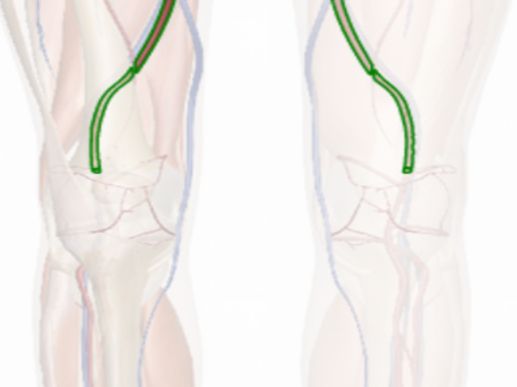 10 Best Clinics for Femoral Artery Bypass Surgery in Thailand [2020 Prices]