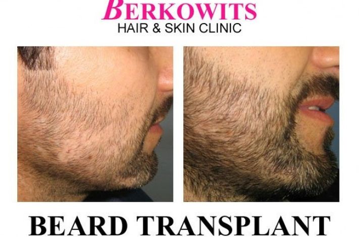 Berkowits Hair & Skin Clinic(Connaught Place)