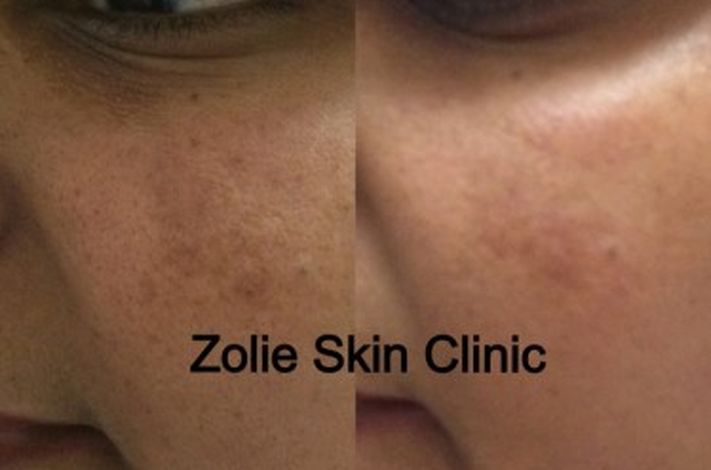 Zolie Skin Clinic - Delhi