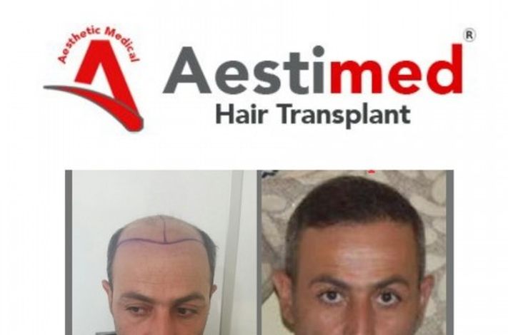 Aestimed Hair Transplant