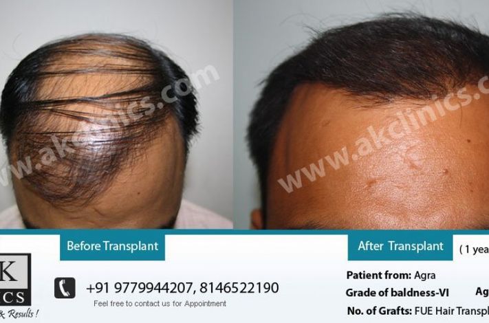 AK Clinics Pvt. Ltd Centre for Hair Transplant - Bangalore