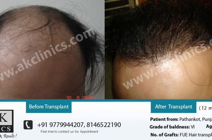 AK Clinics Pvt. Ltd Centre for Hair Transplant - Bangalore