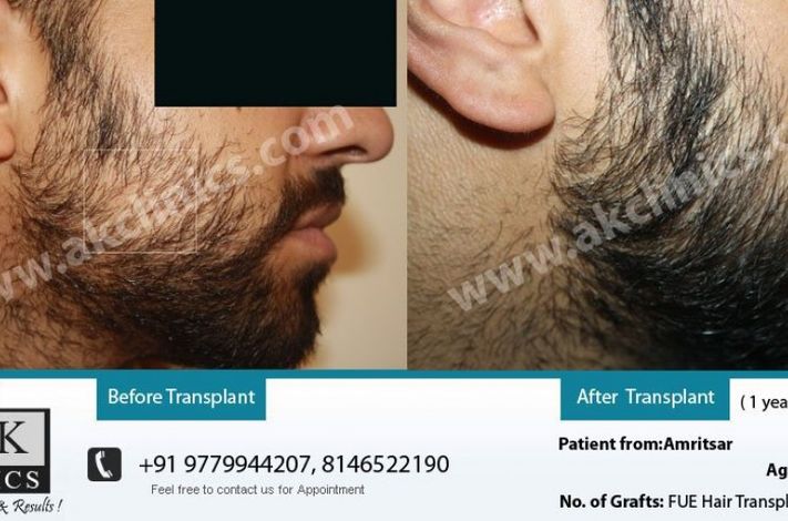 AK Clinics Pvt. Ltd Centre for Hair Transplant - Bangalore