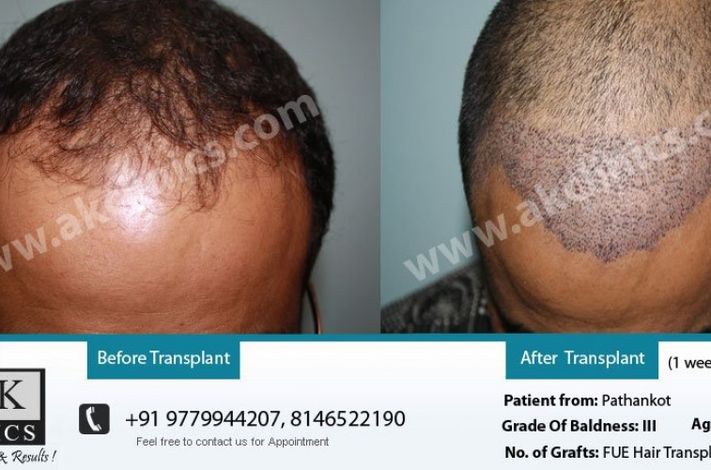 AK Clinics Pvt. Ltd Centre for Hair Transplant - Bangalore