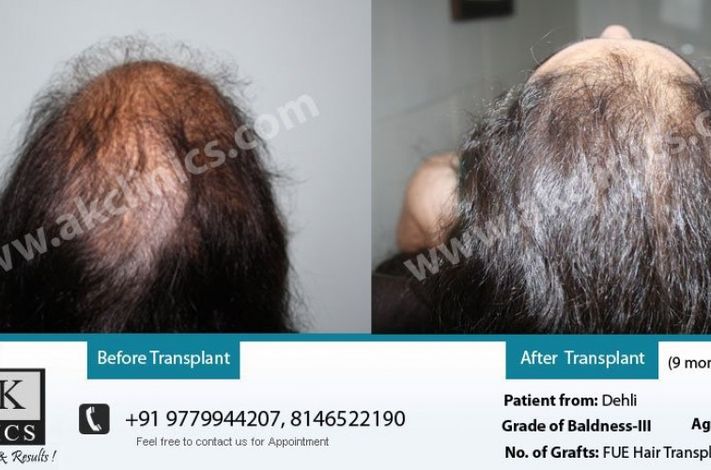 AK Clinics Pvt. Ltd Centre for Hair Transplant - Bangalore