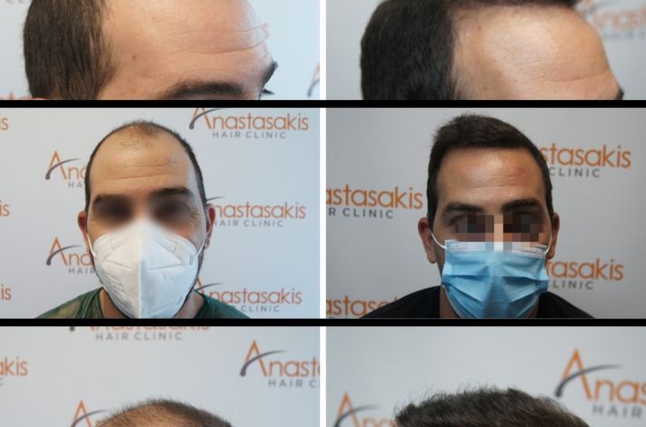 Anastasakis Hair Clinic