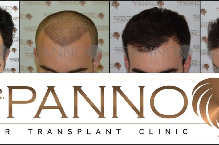 Hair Transplant Malaga Dr. Panno