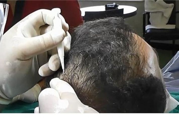 IPF Hair Clinic