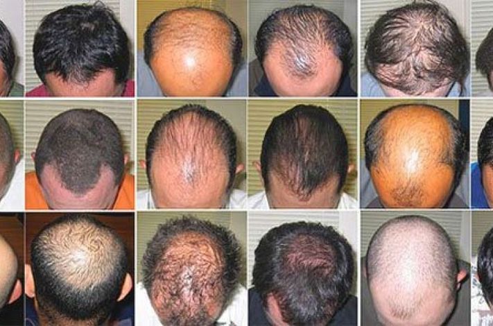 Halo Hair Loss Studio