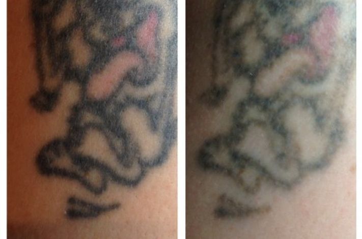 The Missing Ink: Laser Tattoo Removal