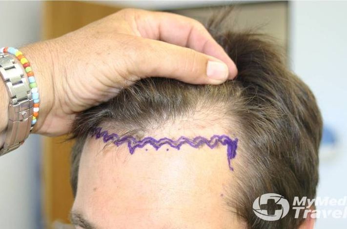 Medical Hair Restoration, Cape Town
