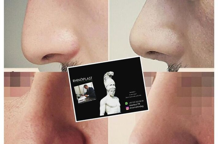 The Nose Aesthetic Clinic - Dr. Cem Altindag