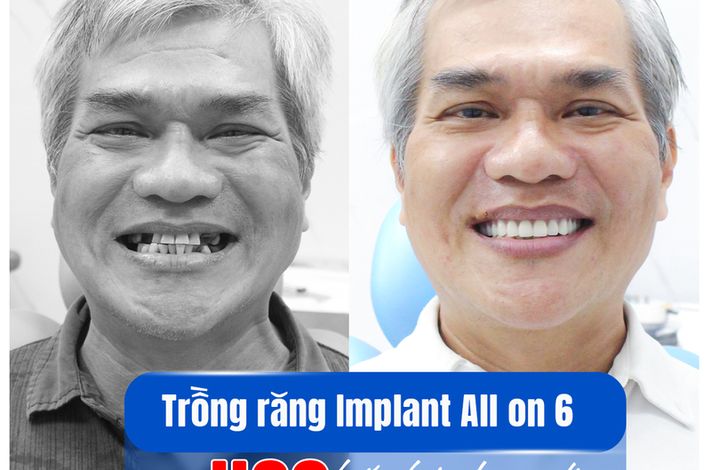 Saigon Dental Implant
