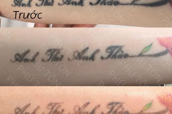 PHU TON - Laser Tattoo Removal