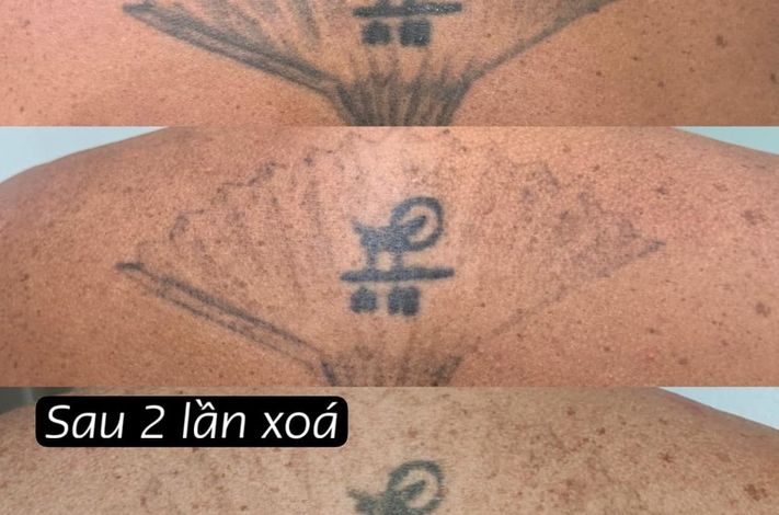 PHU TON - Laser Tattoo Removal