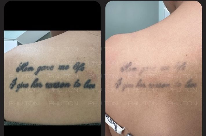 PHU TON - Laser Tattoo Removal