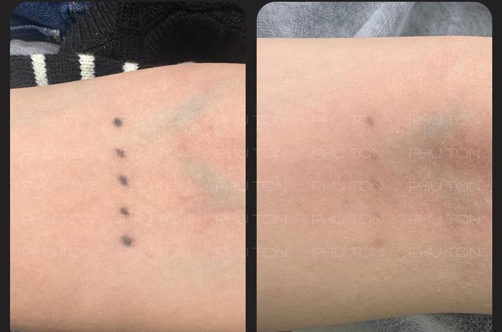 PHU TON - Laser Tattoo Removal