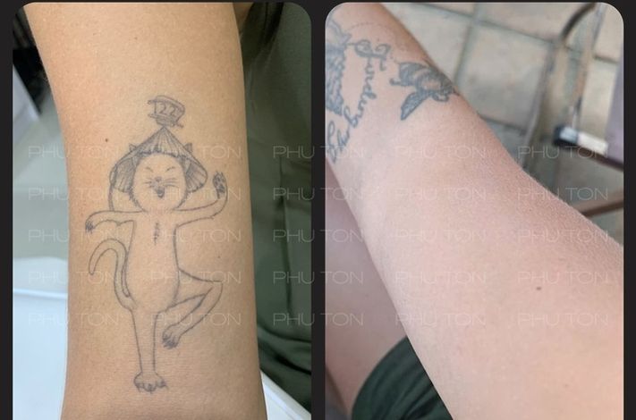 PHU TON - Laser Tattoo Removal