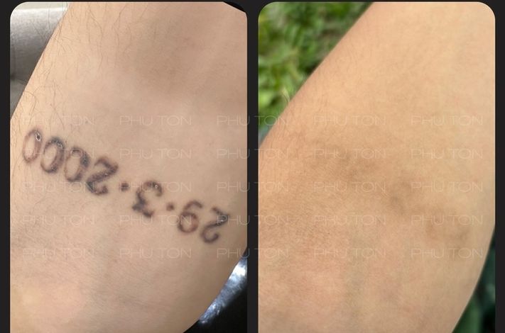 PHU TON - Laser Tattoo Removal