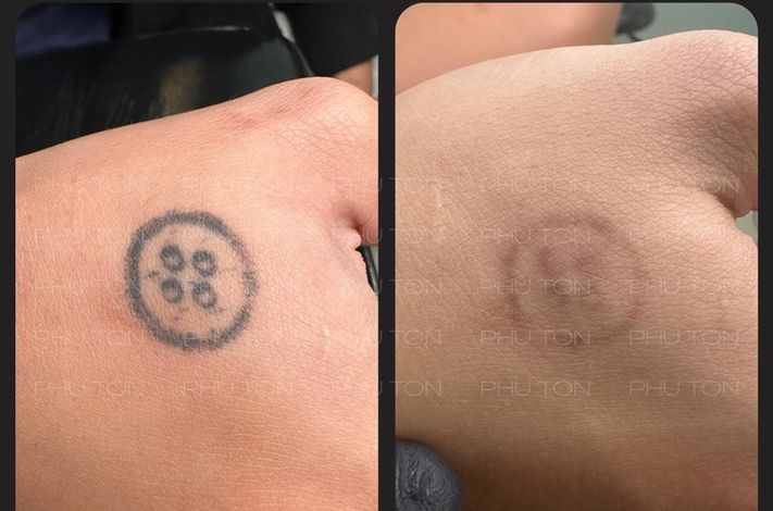 PHU TON - Laser Tattoo Removal